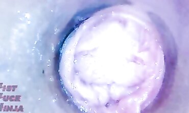 Asian MILF Gets Vaginal Endoscope Exam Again